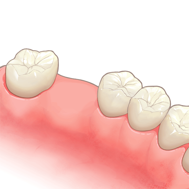 臼歯が一本抜けた状態