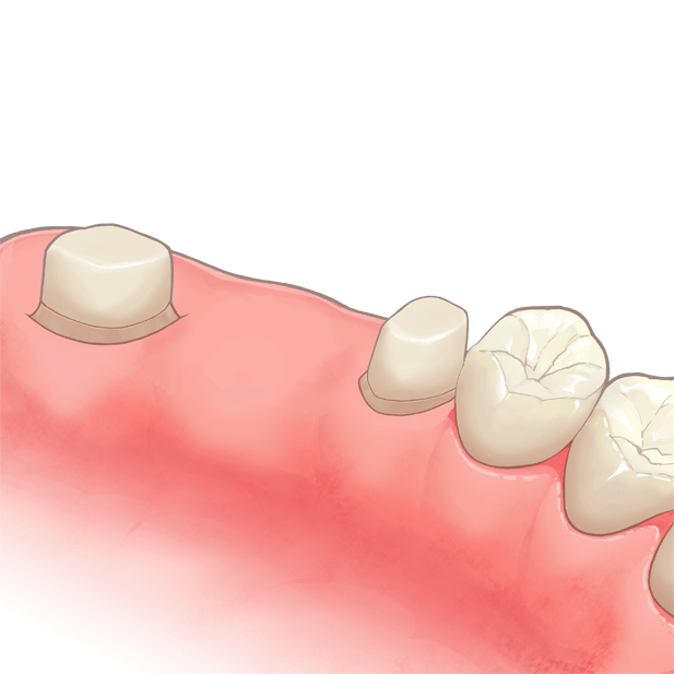 歯を削って土台に