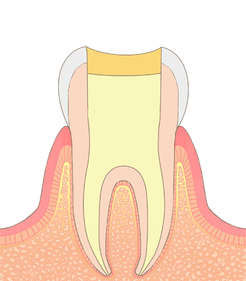 抜髄３