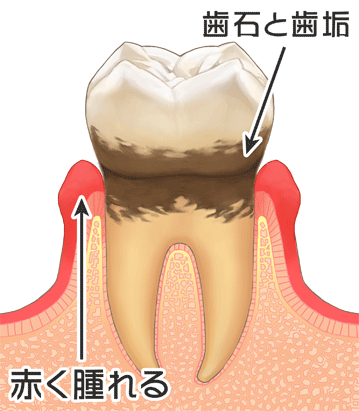 歯肉炎