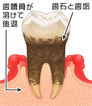 歯周病